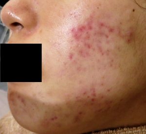 acne-before-left-black