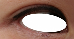 目の下のホクロ取りについて 目黒駅前アキクリニック