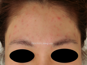 acne1