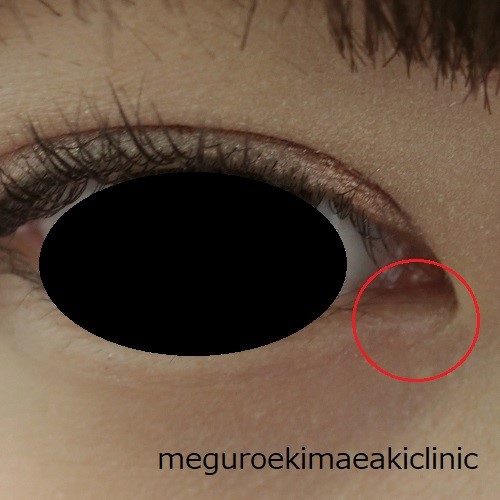 目のふちにできた稗粒腫 はいりゅうしゅ ひりゅうしゅ も安全に治療できます 目黒駅前アキクリニック