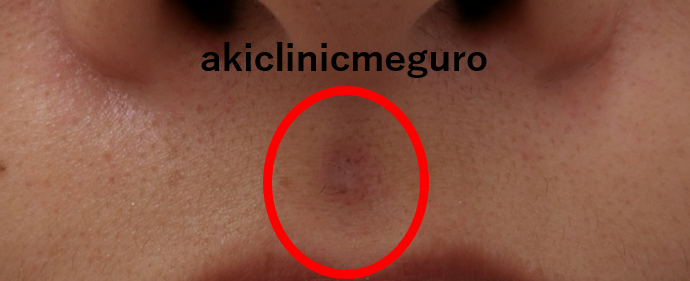 鼻の下にできたホクロ 目黒駅前アキクリニック