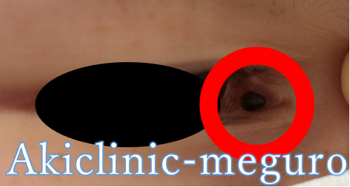 左目のほくろページ Matt、顔のホクロ8個除去を報告…すっぴんのアフター写真が