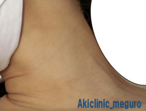 色素沈着　首　症例写真　10回治療後