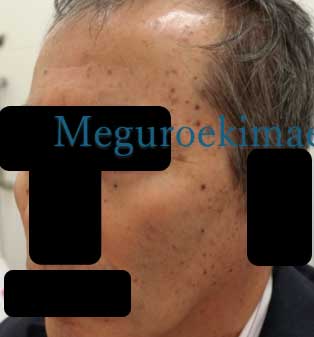 肌トラブル改善コース（フォトフェイシャルM22＋イオン導入）　症例写真　治療前