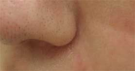 クレーター治療　症例写真　5回治療後