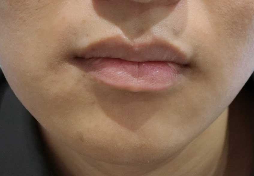 メンズ医療脱毛（ひげセット）　症例写真　脱毛5回後