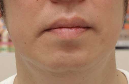 メンズ医療脱毛（ひげセット）　症例写真　脱毛5回後