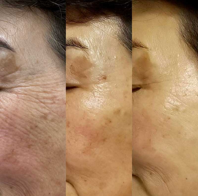 目周りもギリギリまで施術が可能