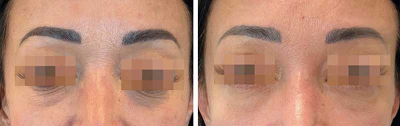 目の下にあるクマを改善