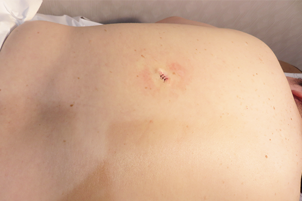 皮膚腫瘍で使用　軟性線維腫＠背部術後