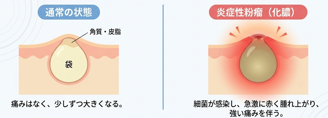 通常の状態と炎症性粉瘤のイメージ図